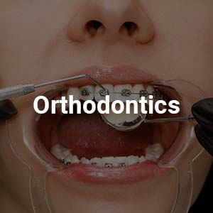 Bracers / Clean Aligners